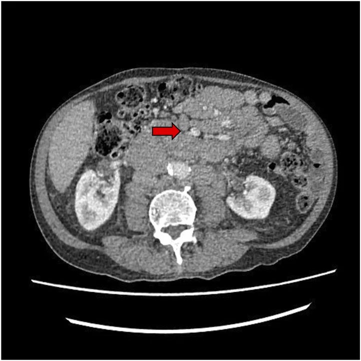 A patient, who was diagnosed with Stage I Lung Adenocarcinoma