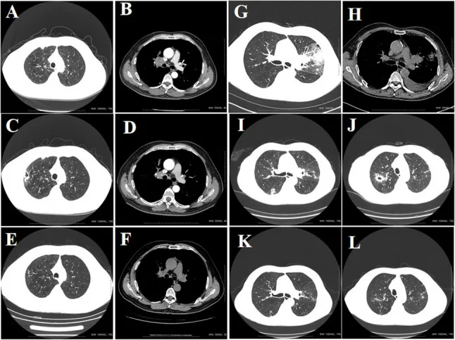A patient, who was diagnosed with Stage III Lung Squamous Cell Carcinoma
