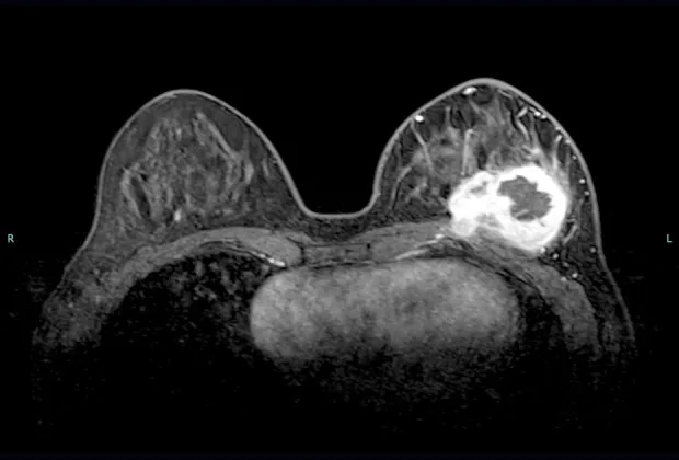 A patient, who was diagnosed with Stage IV Breast Cancer