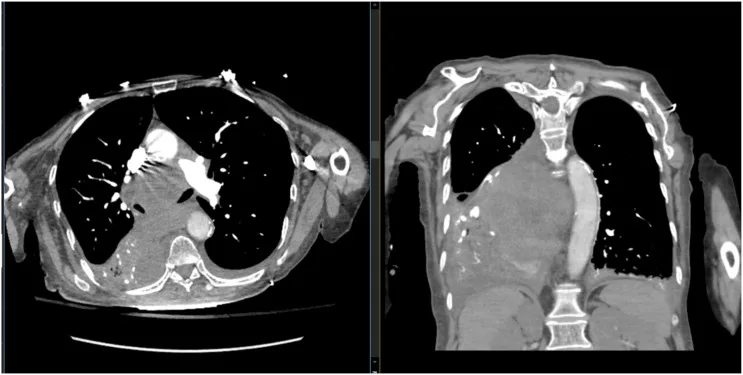 A patient, who was diagnosed with Colorectal Adenocarcinoma