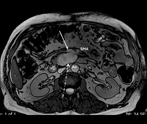 A patient, who was diagnosed with Stage IV Colorectal Adenocarcinoma
