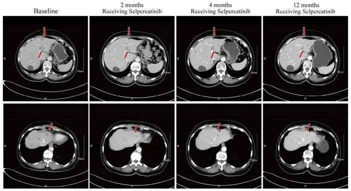 A patient, who was diagnosed with Stage IV Colorectal Adenocarcinoma