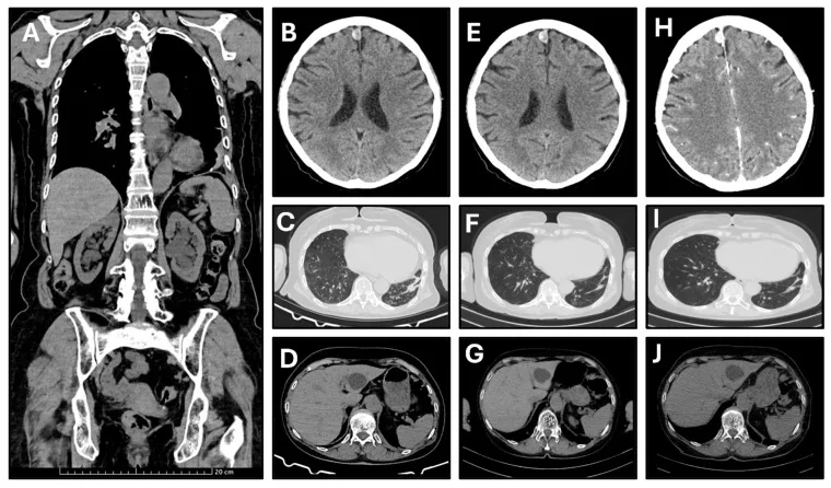 A patient, who was diagnosed with Stage IV Lung Adenocarcinoma