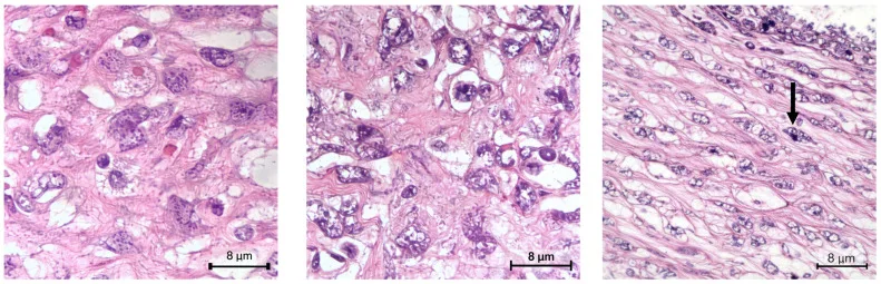A patient, who was diagnosed with Breast Cancer