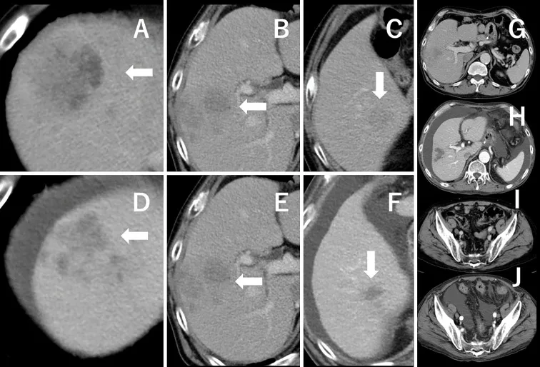 A patient, who was diagnosed with Stage IV Gastric Adenocarcinoma