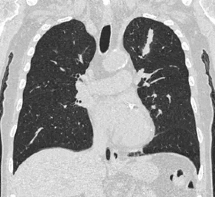 A patient, who was diagnosed with Small Cell Lung Cancer