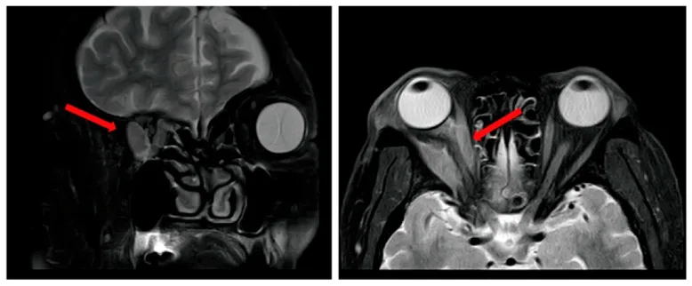 A patient, who was diagnosed with Stage IV Invasive Ductal Carcinoma