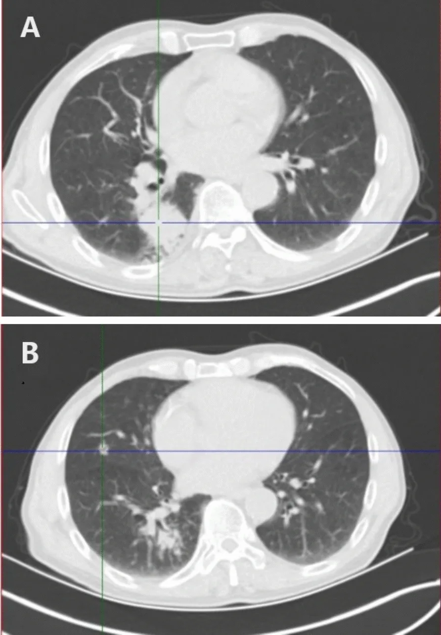 A patient, who was diagnosed with Lung Adenocarcinoma