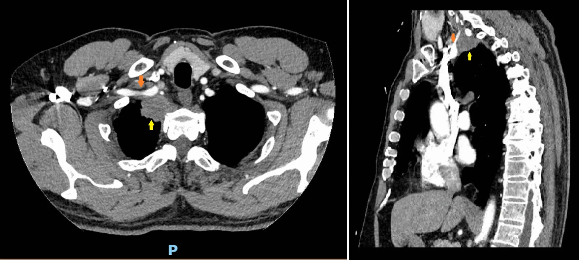 A patient, who was diagnosed with Stage II Lung Adenocarcinoma