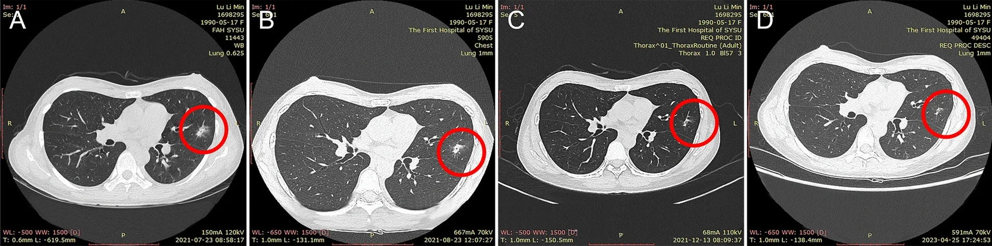 A patient, who was diagnosed with Inflammatory Breast Cancer