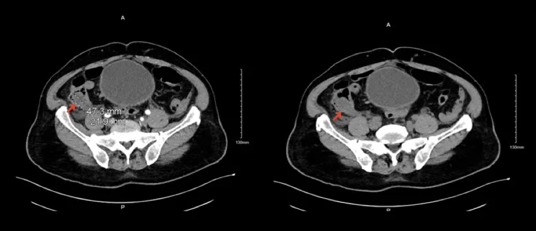 A patient, who was diagnosed with Colorectal Cancer