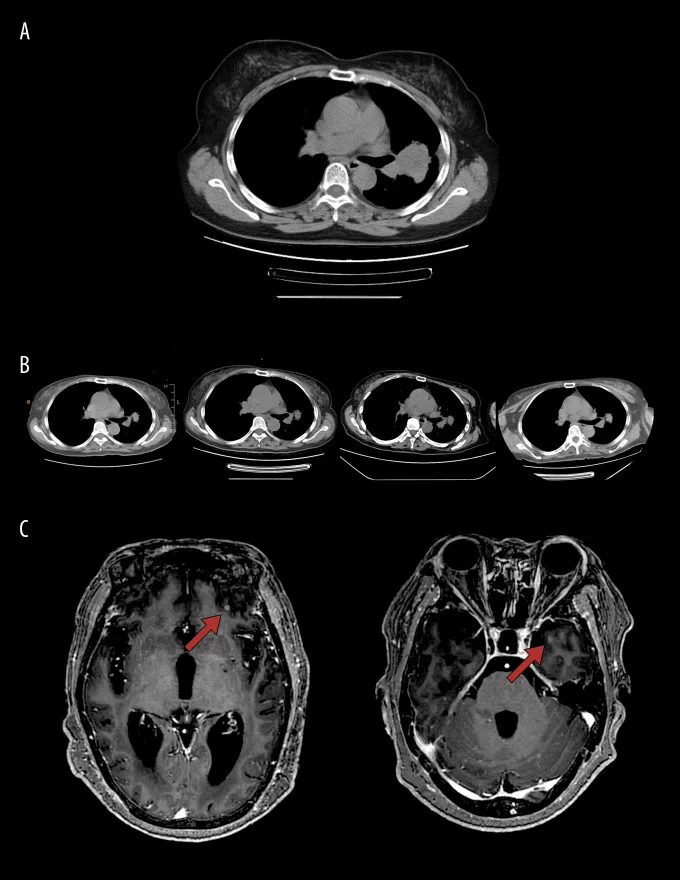 A patient, who was diagnosed with Stage IV Non-Small Cell Lung Cancer