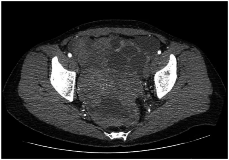A patient, who was diagnosed with Stage III Ovarian Cancer