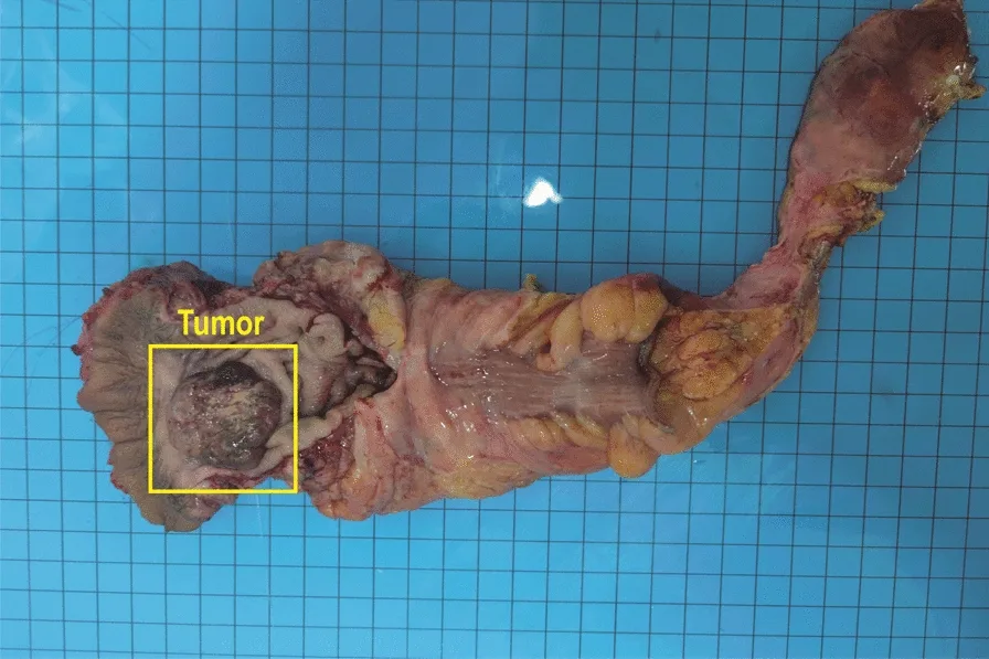 A patient, who was diagnosed with Stage I Anorectal Melanoma
