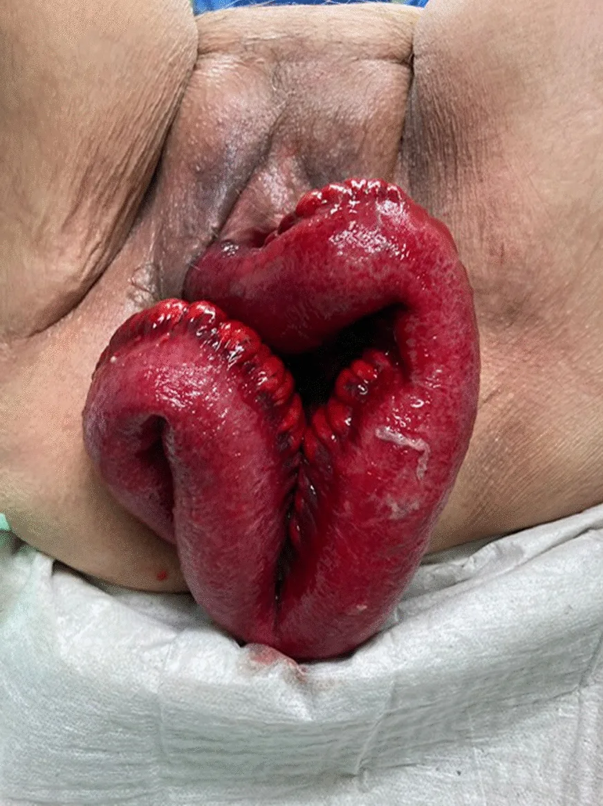 A patient, who was diagnosed with Stage III Breast Cancer