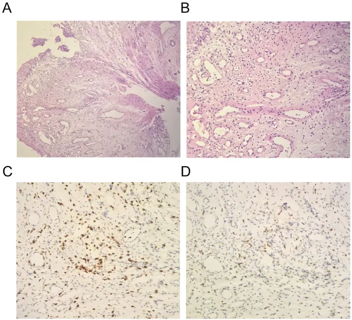 A patient, who was diagnosed with Small Cell Lung Cancer