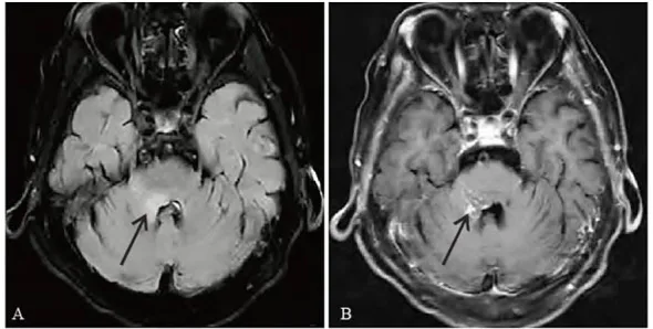 A patient, who was diagnosed with Stage IV Lung Adenocarcinoma