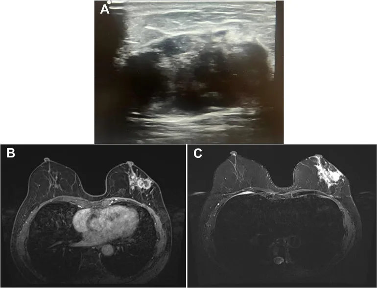 A patient, who was diagnosed with Stage II Breast Cancer