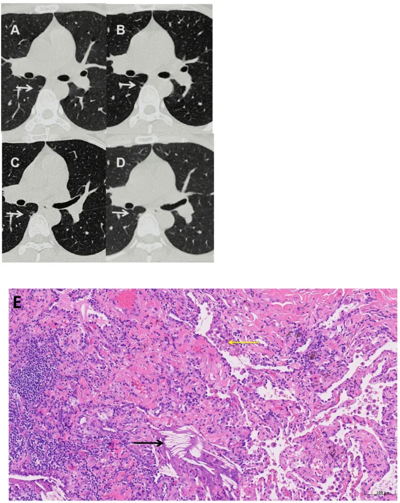 A patient, who was diagnosed with Lung Adenocarcinoma