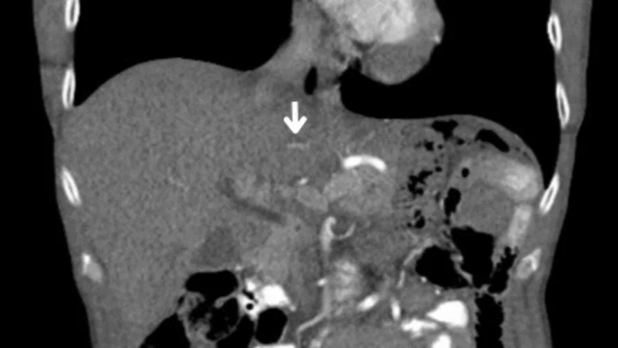 A patient, who was diagnosed with Gastric Adenocarcinoma