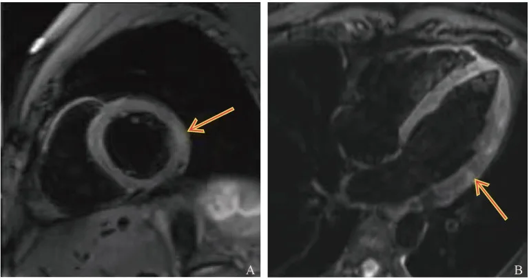 A patient, who was diagnosed with Lung Adenocarcinoma
