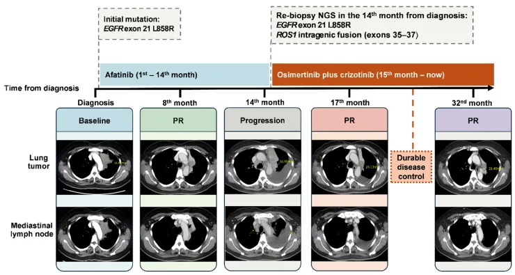 A patient, who was diagnosed with Stage IV Lung Adenocarcinoma