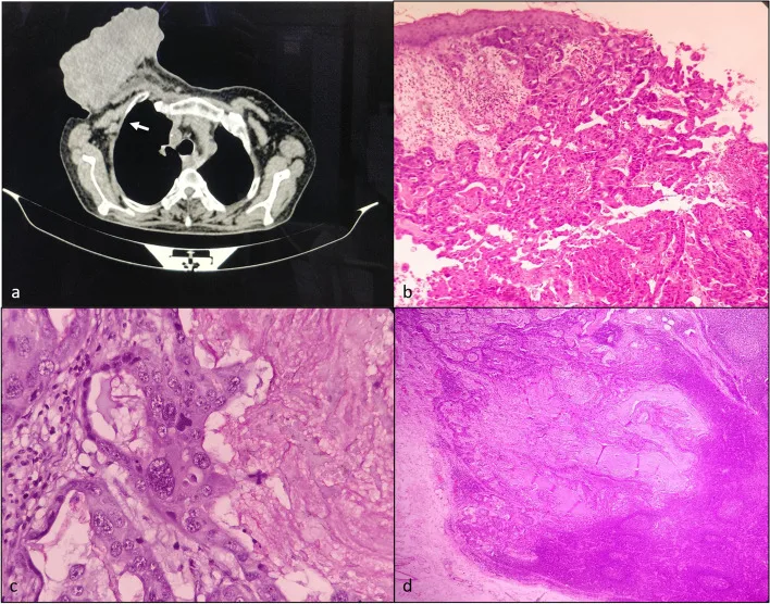 A patient, who was diagnosed with Breast Cancer
