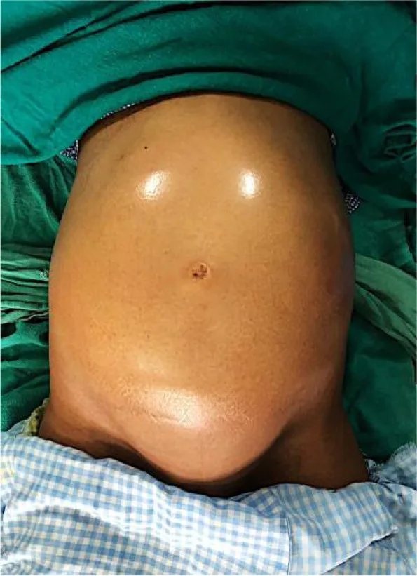 A patient, who was diagnosed with Stage IV Ovarian Adenocarcinoma