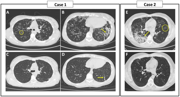 A patient, who was diagnosed with Stage IV Lung Adenocarcinoma