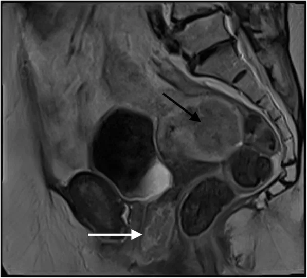 A patient, who was diagnosed with Stage IV Colorectal Adenocarcinoma