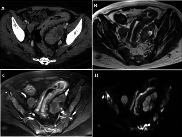 A patient, who was diagnosed with Stage IV Colorectal Adenocarcinoma