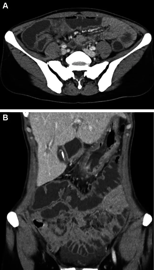 A patient, who was diagnosed with Stage IV Breast Cancer