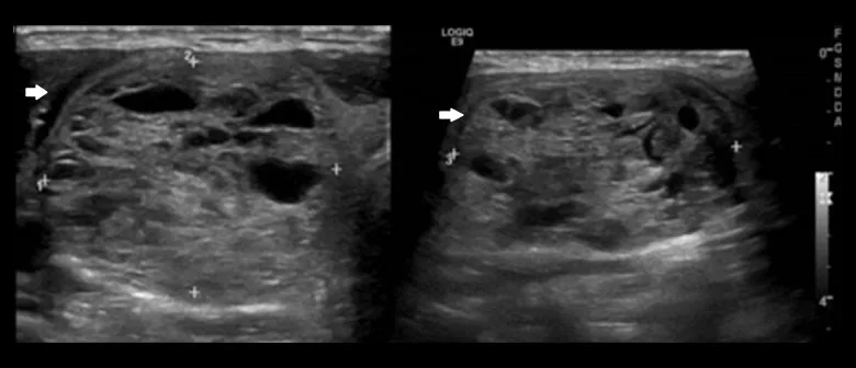 A patient, who was diagnosed with Stage IV Lung Adenocarcinoma