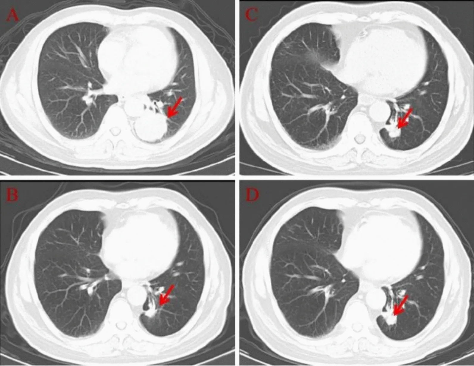 A patient, who was diagnosed with Stage IV Lung Adenocarcinoma