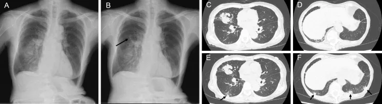 A patient, who was diagnosed with Stage IV Lung Adenocarcinoma