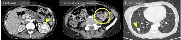 A patient, who was diagnosed with Stage IV Colorectal Adenocarcinoma