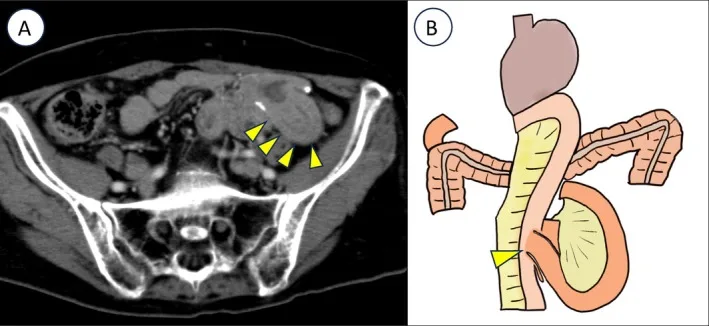 A patient, who was diagnosed with Stage I Gastric Adenocarcinoma
