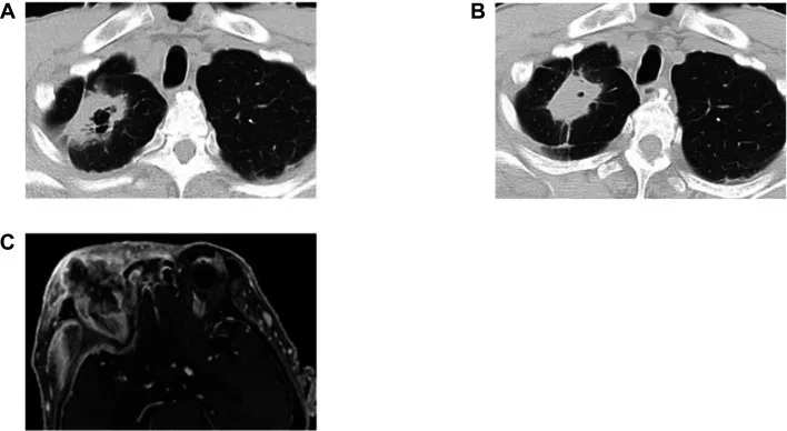 A patient, who was diagnosed with Stage IV Non-Small Cell Lung Cancer