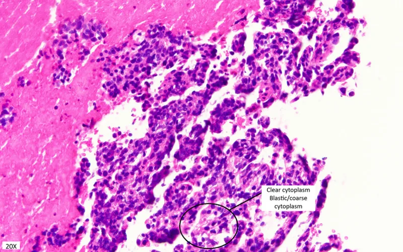 A patient, who was diagnosed with Stage IV Colorectal Adenocarcinoma