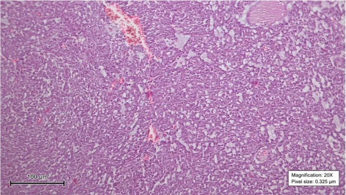 A patient, who was diagnosed with Stage IV Small Cell Lung Cancer