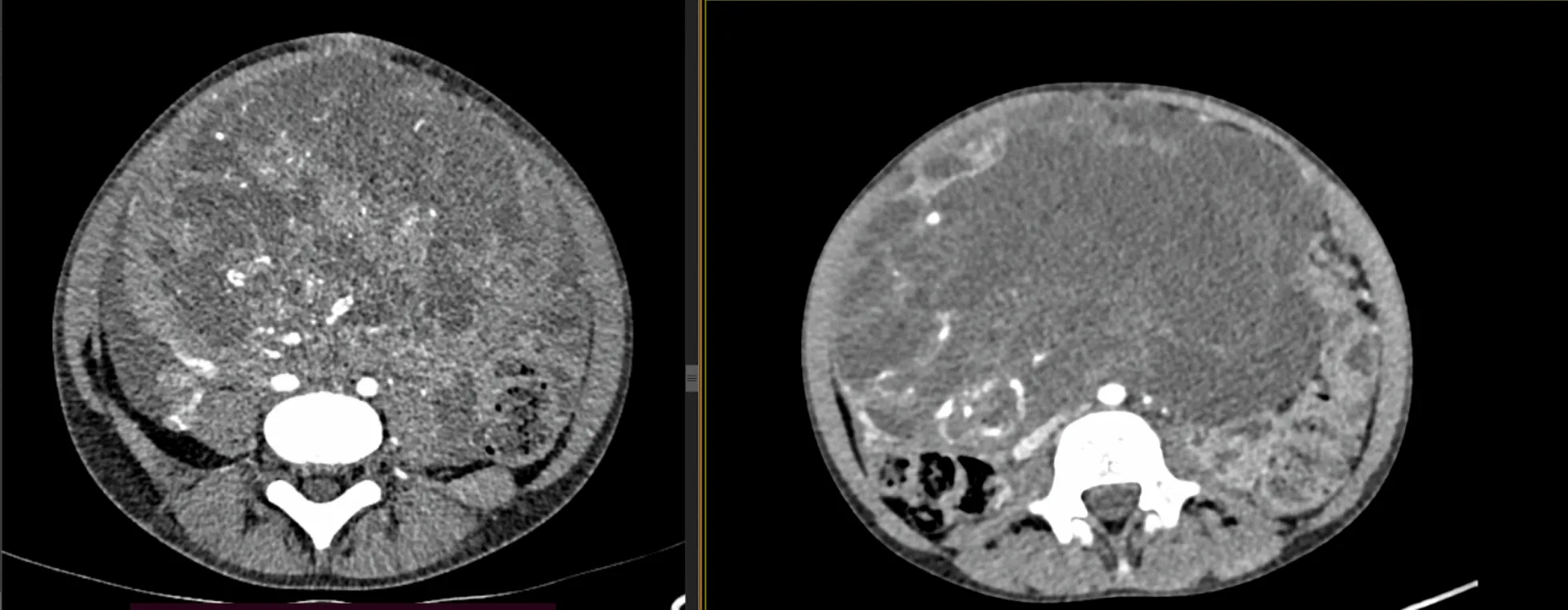 A patient, who was diagnosed with Ovarian Cancer