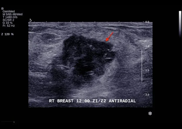 A patient, who was diagnosed with Stage IV Small Cell Lung Cancer