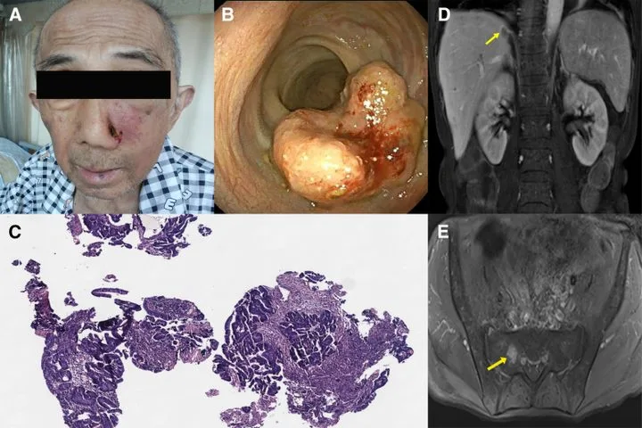 A patient, who was diagnosed with Stage IV Colorectal Adenocarcinoma