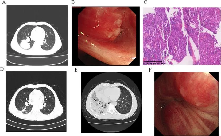 A patient, who was diagnosed with Lung Squamous Cell Carcinoma