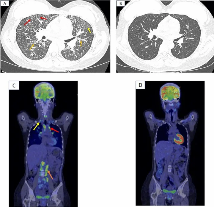 A patient, who was diagnosed with Stage IV Colorectal Adenocarcinoma