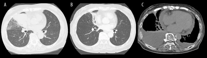 A patient, who was diagnosed with Stage III Lung Squamous Cell Carcinoma