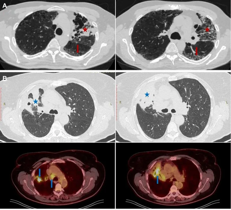 A patient, who was diagnosed with Lung Adenocarcinoma