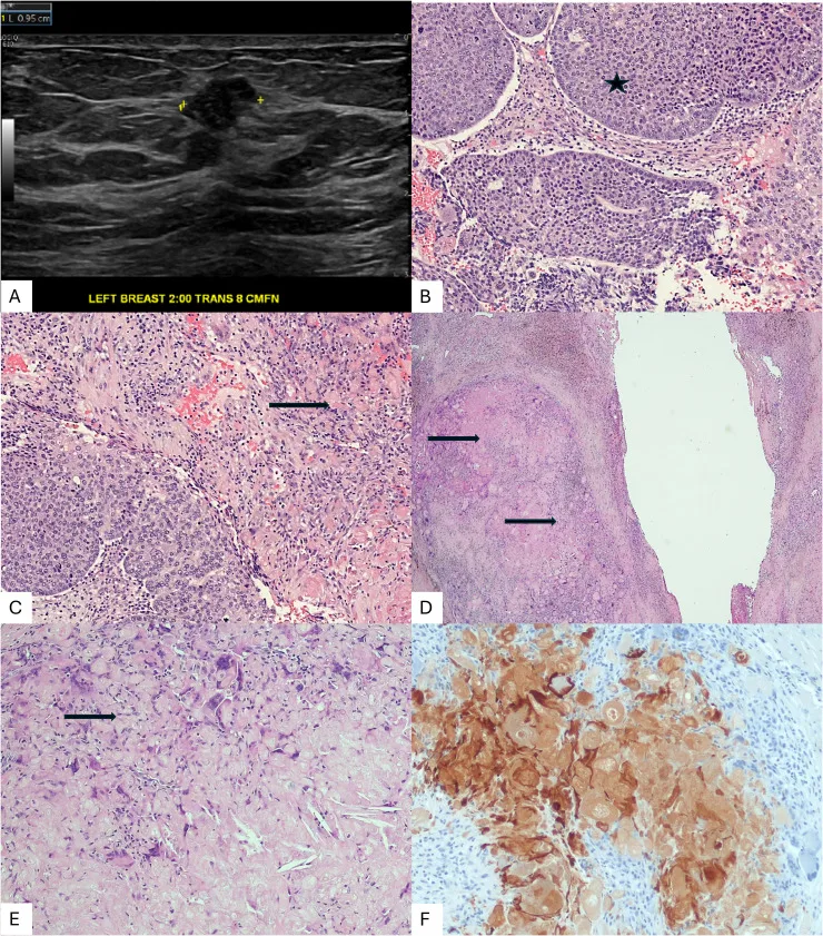 A patient, who was diagnosed with Breast Squamous Cell Carcinoma