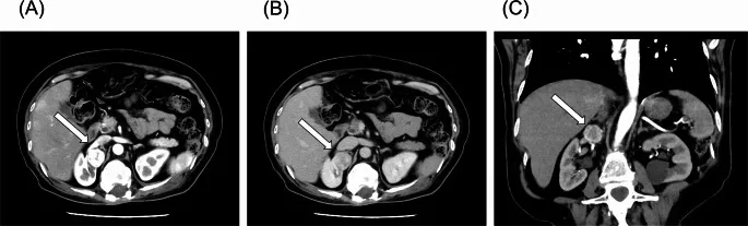 A patient, who was diagnosed with Stage IV Invasive Ductal Carcinoma