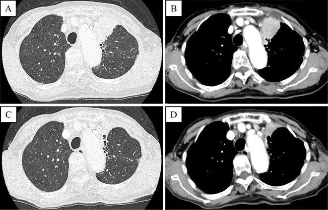 A patient, who was diagnosed with Stage IV Lung Adenocarcinoma